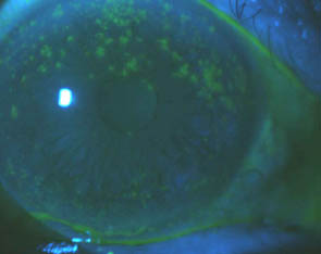 Superior Corneal Staining in Dry Eye